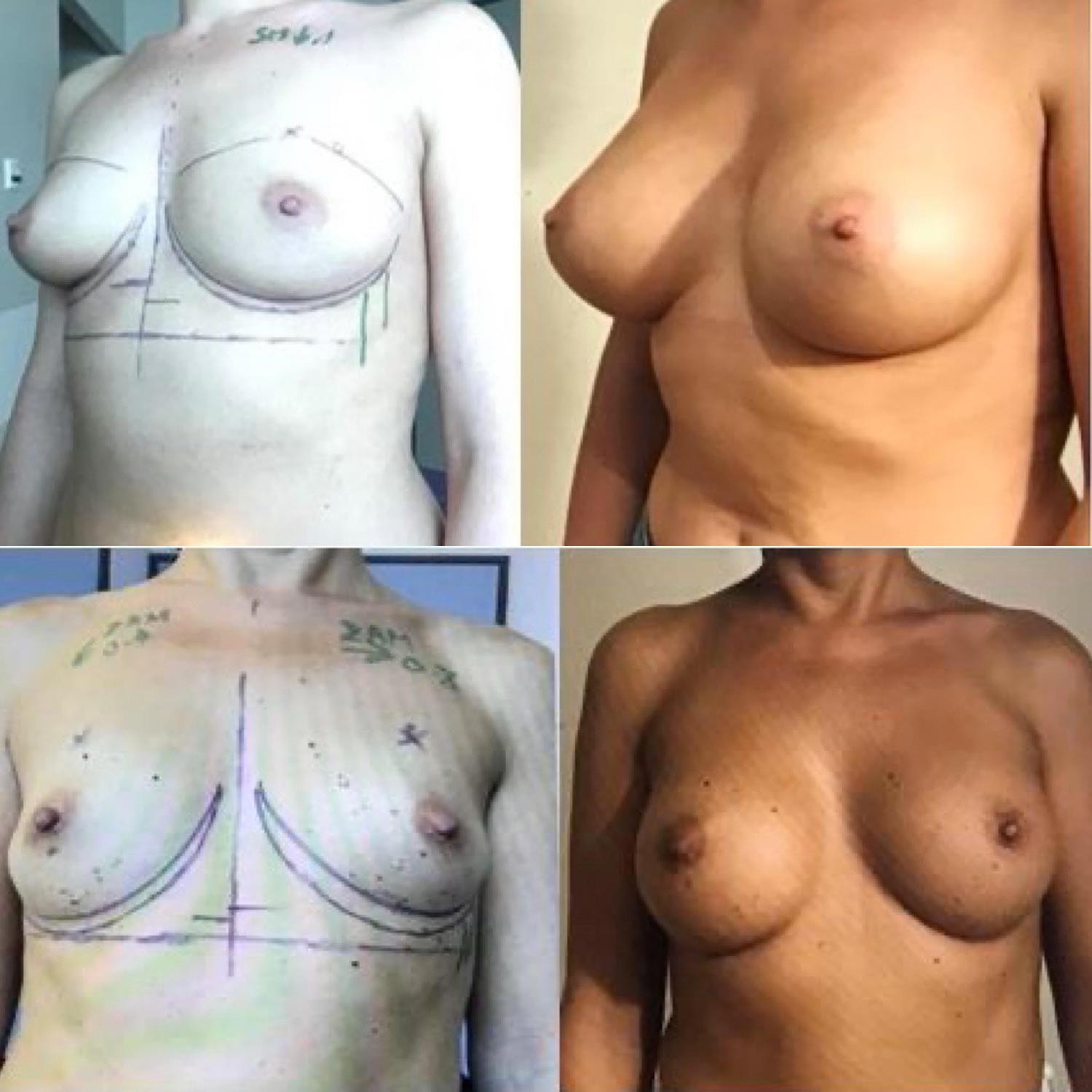 Nouveaux implants anatomiques